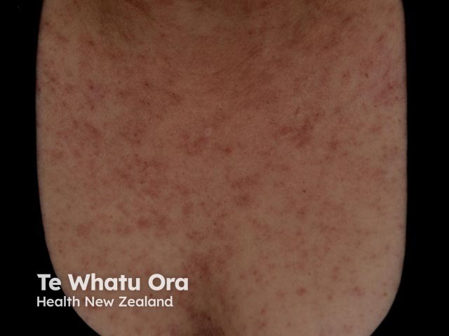 Gambar 3: Ruam campak. Credit: Dermnetnz.org